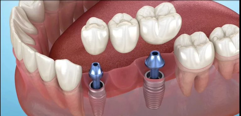 Puente sobre implantes