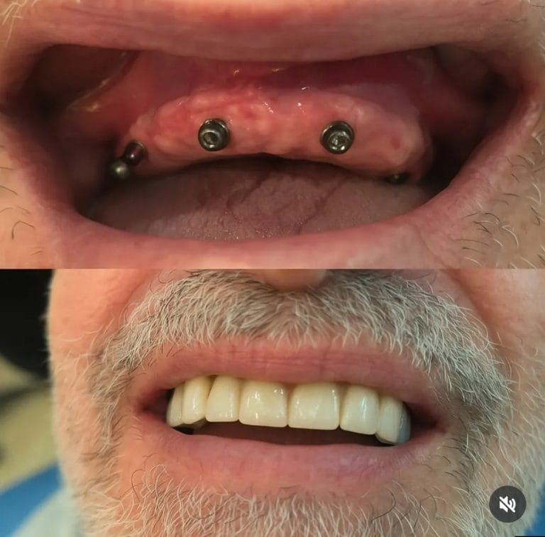 Caso real de implantes dentales - rehabilitación fija en Clínica Dental Nin