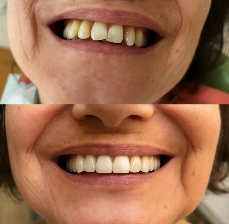 Caso real de implantes antes y después - Clínica Dental Nin
