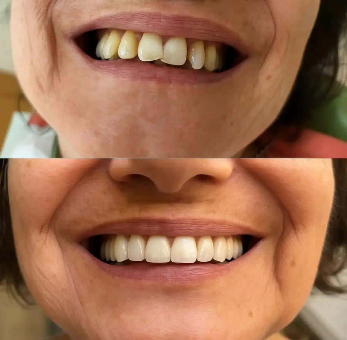 Caso real de implantes antes y después - Clínica Dental Nin