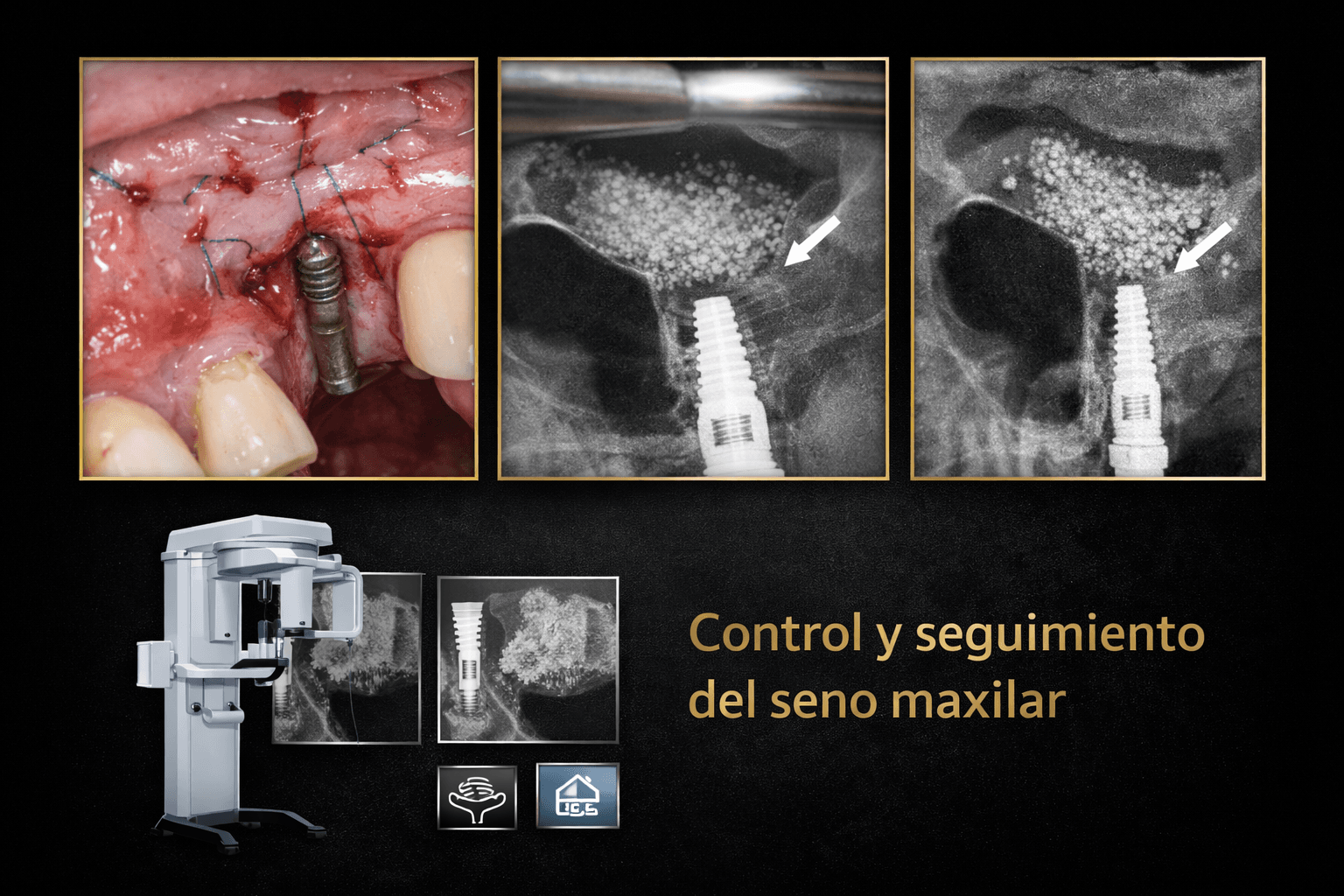Control y seguimiento tras elevación de seno maxilar