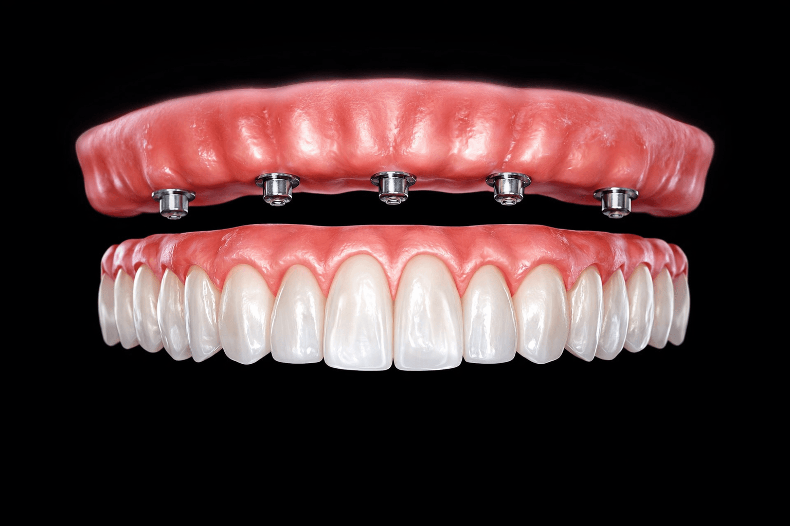 Prótesis atornillada sobre implantes: concepto y mantenimiento