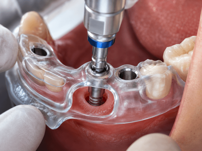 Férula quirúrgica transparente para cirugía guiada de implantes dentales en Barcelona