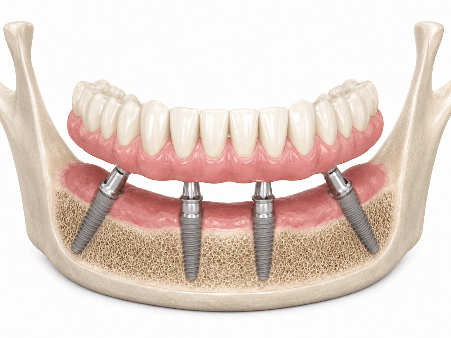 Implantes All-on-4 para rehabilitación fija completa sobre cuatro implantes en Barcelona Sant Gervasi
