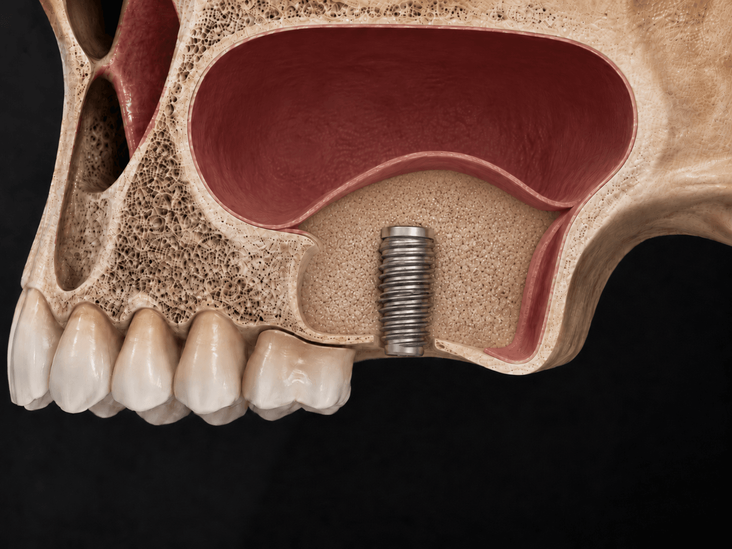 Regeneración ósea consolidada e implante dental en elevación de seno maxilar Barcelona Sant Gervasi