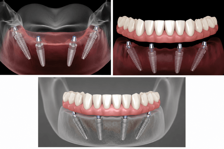 Prótesis fija completa sobre cuatro implantes dentales All-on-4 en Barcelona