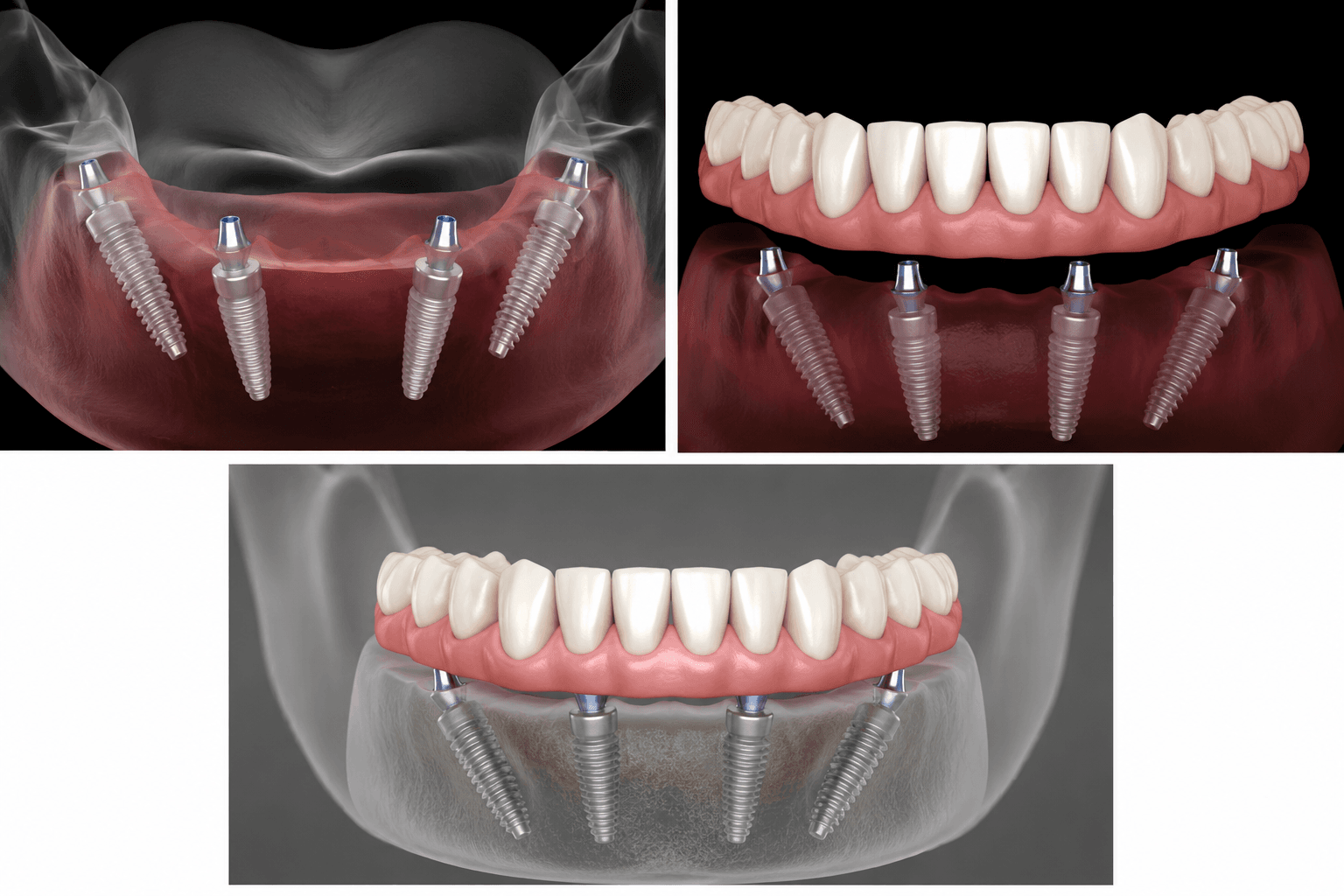 Prótesis fija completa sobre cuatro implantes dentales All-on-4 en Barcelona
