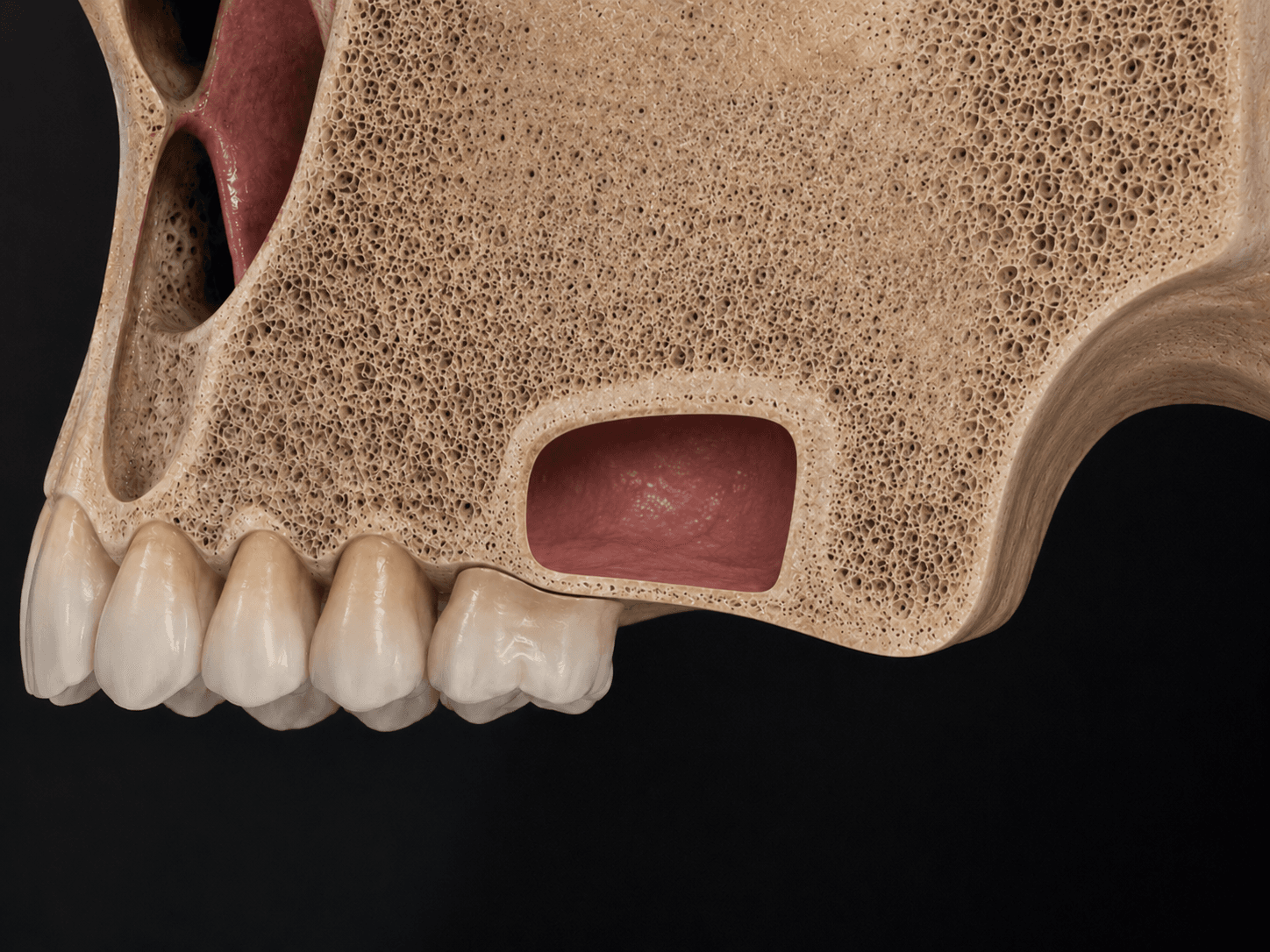 Atrofia ósea en maxilar superior por neumatización del seno antes de colocar implantes en Sant Gervasi Barcelona
