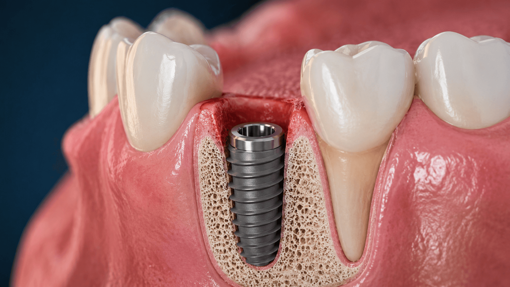 Implante inmediato postextracción en Clínica Dental Nin Barcelona Sant Gervasi