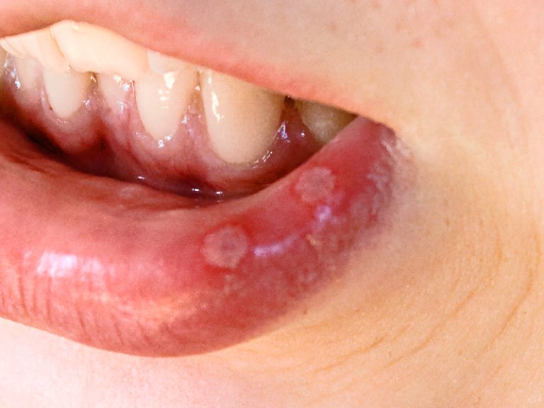 Fotografía clínica de dos aftas en la cara interna del labio inferior