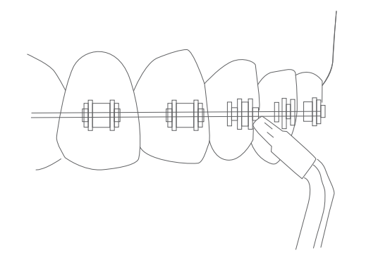 Punta ortodóncica Turewell para brackets