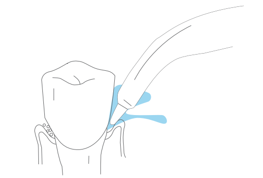 Punta periodontal para irrigador Turewell